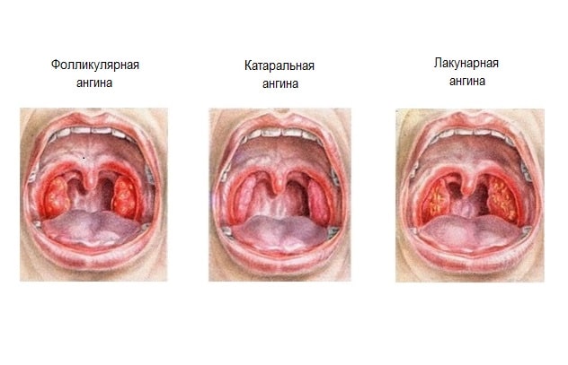 Катаральна ангіна – симптоми і лікування у дорослих і дітей