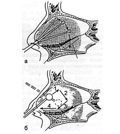 Схема відділення слизової оболонки і надхрящніци від поверхні носової перегородки з закритого (а) і відкритого (б) доступів (стрілки і цифри вказують послідовність обробки різних ділянок перегородки)