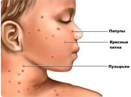 Гнійні папули при вітрянці: причини і методи лікування