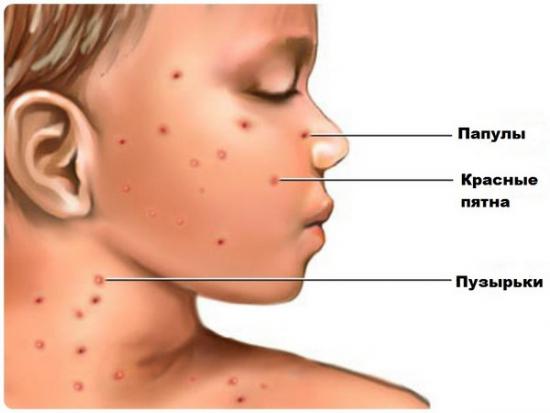 Гнійні папули при вітрянці: причини і методи лікування