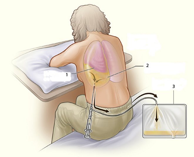 Схематичне зображення плевральної пункції: 1 - ліве легке, стиснуті рідиною в плевральній порожнині;  2 - вільна рідина в лівій плевральній порожнині;  3 - резервуар для збору відсмоктуваної з плевральної порожнини рідини.