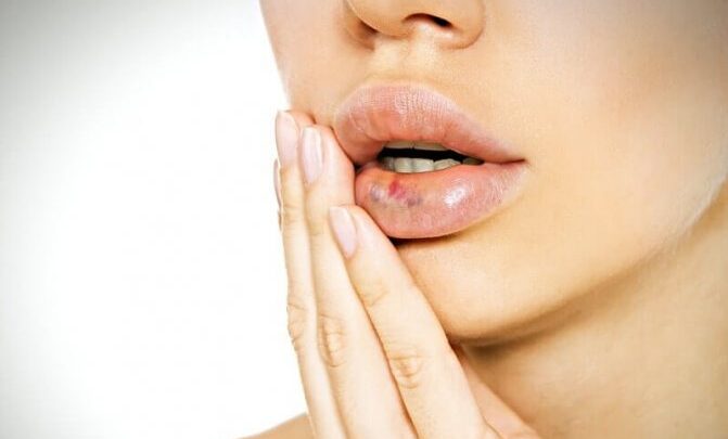 Розбита губа як зняти пухлина народними засобами
