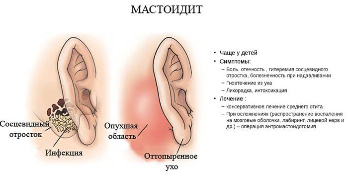 Симптоми і лікування мастоидита