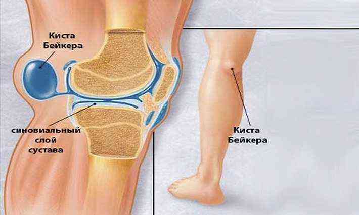 симптоми кісти Бейкера колінного суглоба