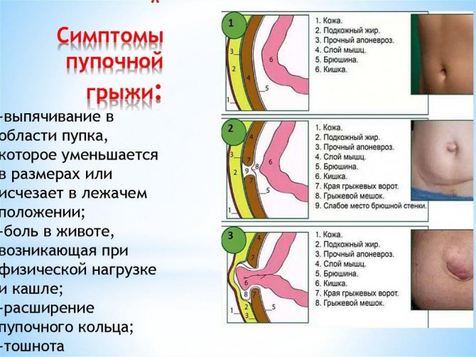 Симптоми пупкової грижі