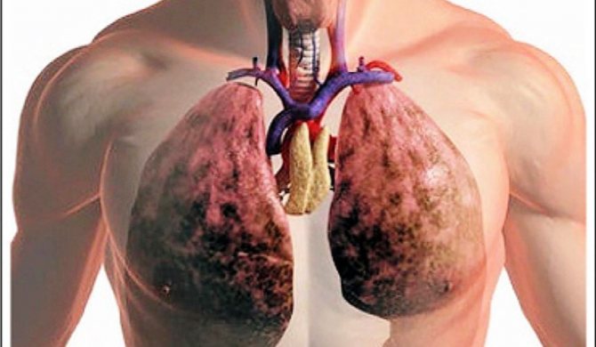 Що таке тромбофлебіт легеневої артерії: симптоми і методи лікування