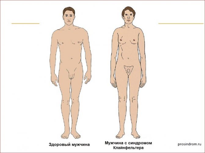 синдром Клайнфельтера