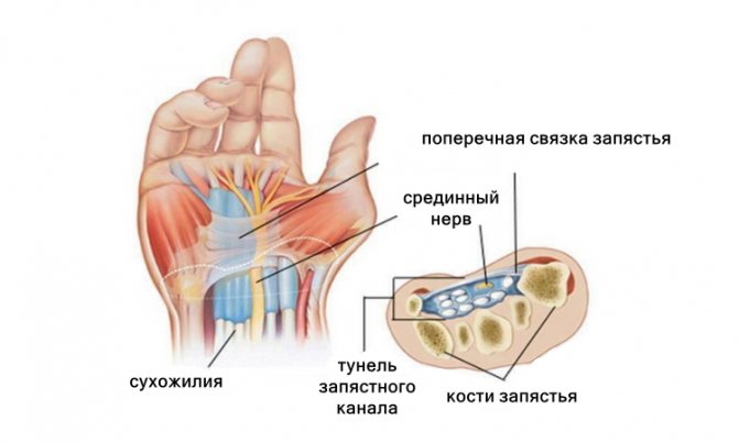 Синдром зап'ястного каналу, тунельний синдром