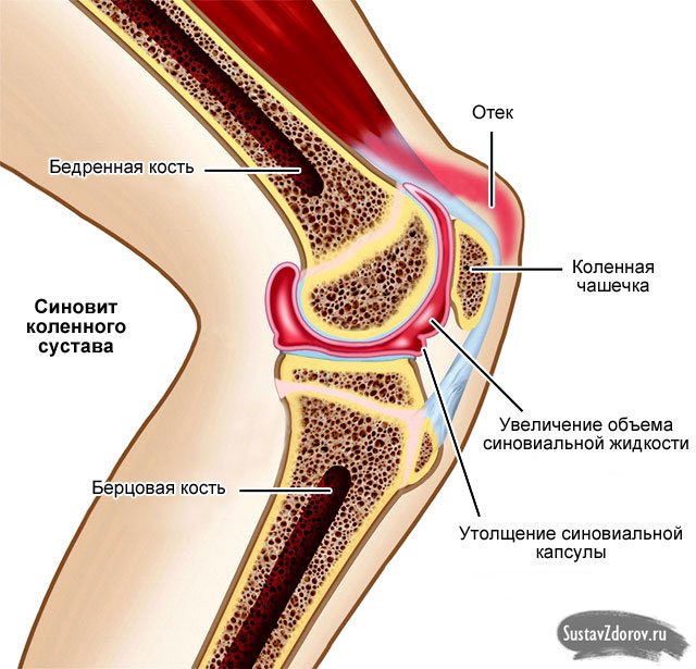 синовит колінного суглоба