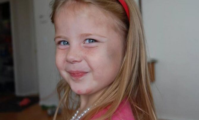 Як довго проходить синяк і стадії гематоми м’яких тканин