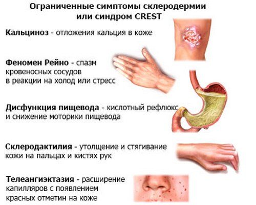 Симптоми і лікування прогресуючого системного склерозу: що робити при важку недугу сполучної тканини?