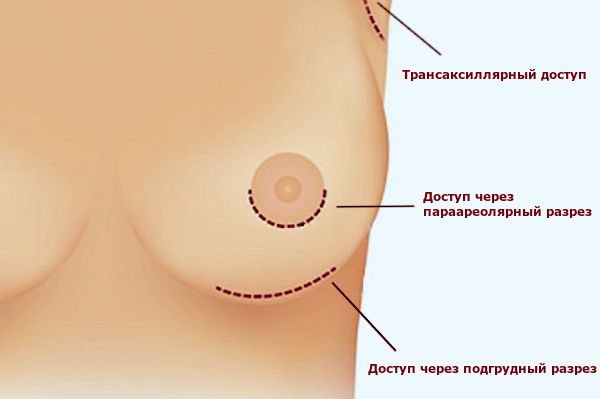 Скільки коштує операція по збільшенню грудей