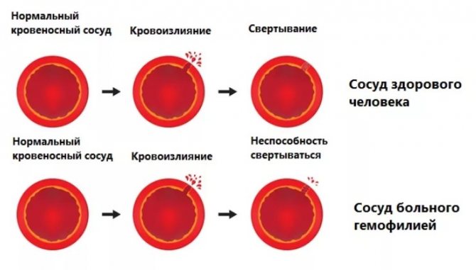 Середній обсяг еритроцитів (MCV): що це, норма і відхилення, причини підвищення і пониження