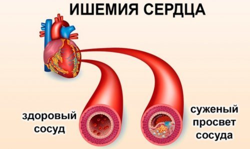 Судини при ішемії