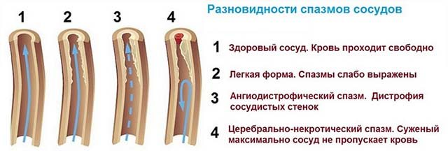 спазм судин