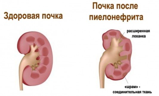 Запалення нирок: симптоми, лікування препаратами та народними засобами