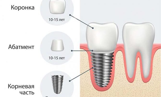 Зняття швів після імплантації зубів коли через скільки боляче