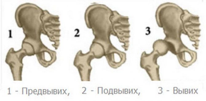 Рентгенологічні ознаки дисплазії тазостегнових суглобів у дітей