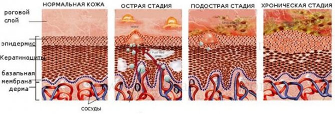 стадії екземи