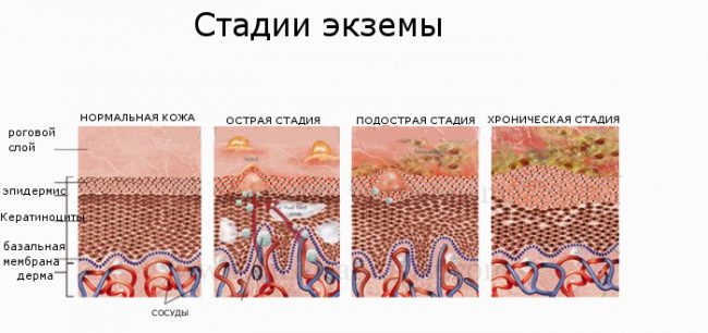 стадії екземи