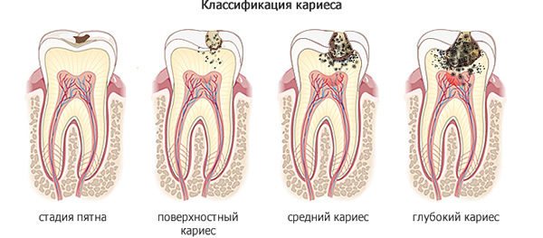 стадії карієсу