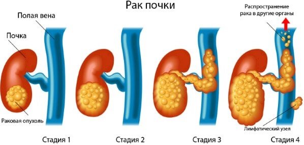 стадії раку нирок