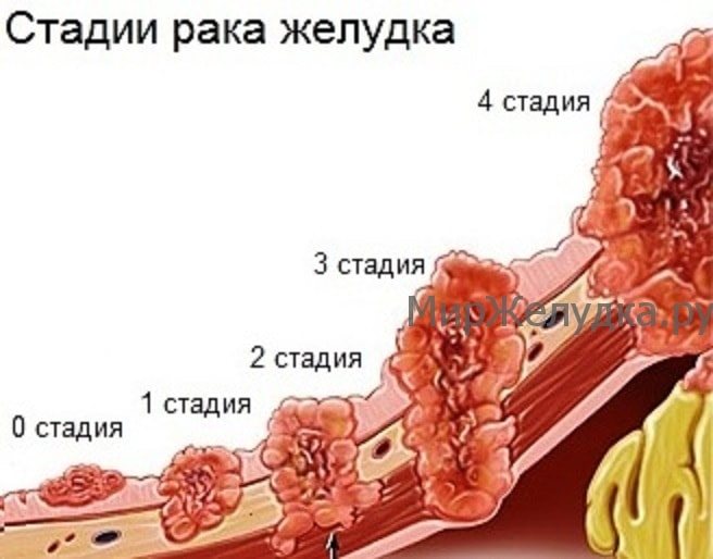 Стадії раку шлунка