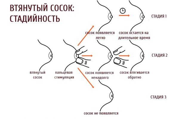 Стадії розробки втягнутого соска