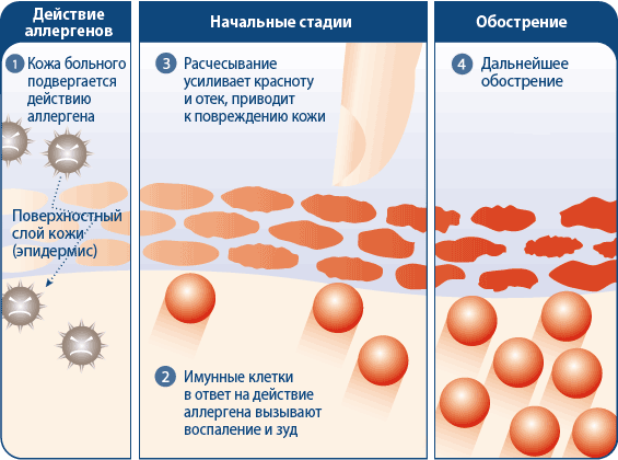 Особливості лікування простого контактного дерматиту