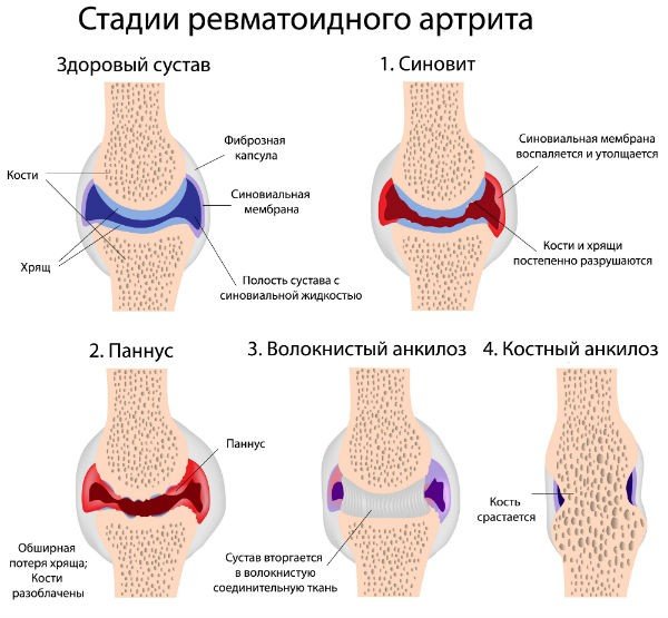 Стадії ревматоїдного артриту