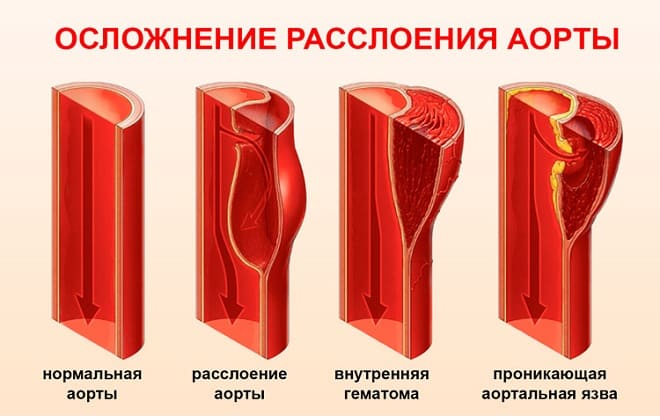 Ступеня розшарування аорти