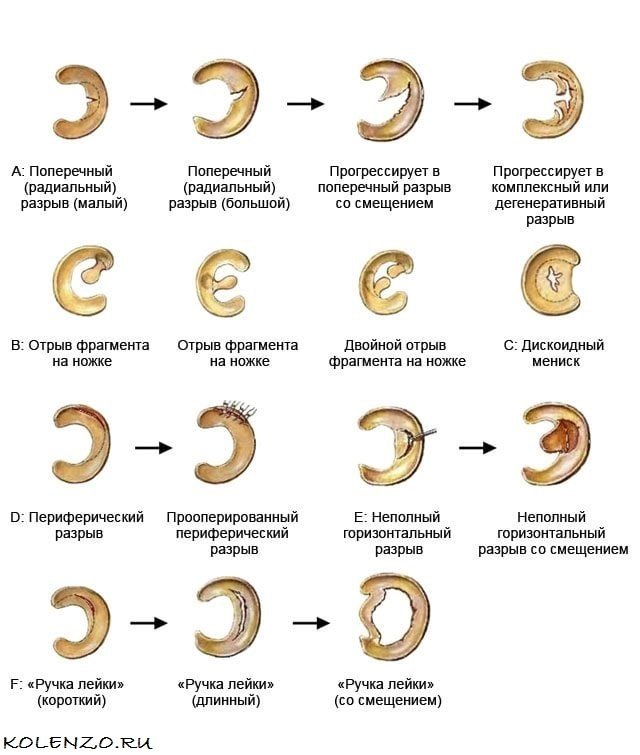 СТУПЕНЯ розриві меніску колінного суглоба
