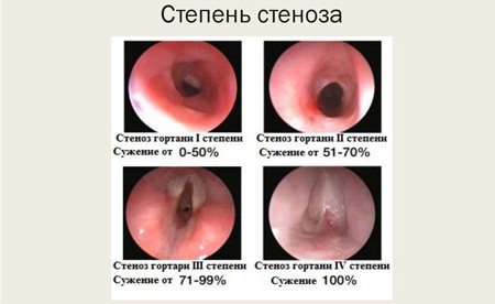 ступеня стенозу