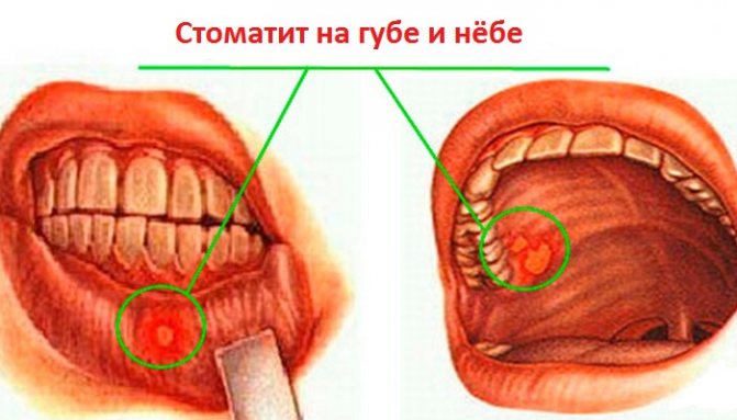 стоматит на губі і на небі