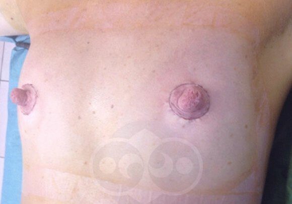 Модель видалила соски, щоб вільно публікувати нюдси в інстаграме. Але операція пройшла тільки в фотошопі