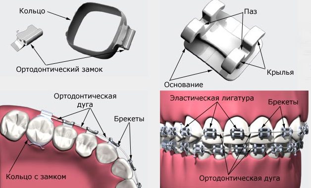 будова брекетів