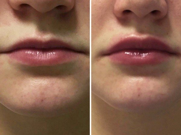 0.5 в губы до и после фото