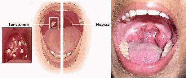 Симптоми і лікування хронічного тонзиліту у дорослих в домашніх умовах