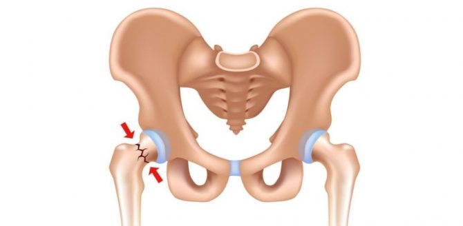 Тріщина шийки стегна симптоми діагностика лікування та наслідки