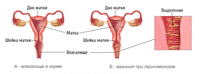 тріхомонадний вагініт