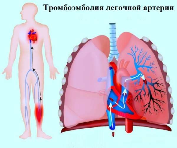 Тромбоемболія легеневої артерії