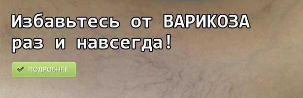 Тромбофлебіт: що це таке, симптоми, діагностика та лікування