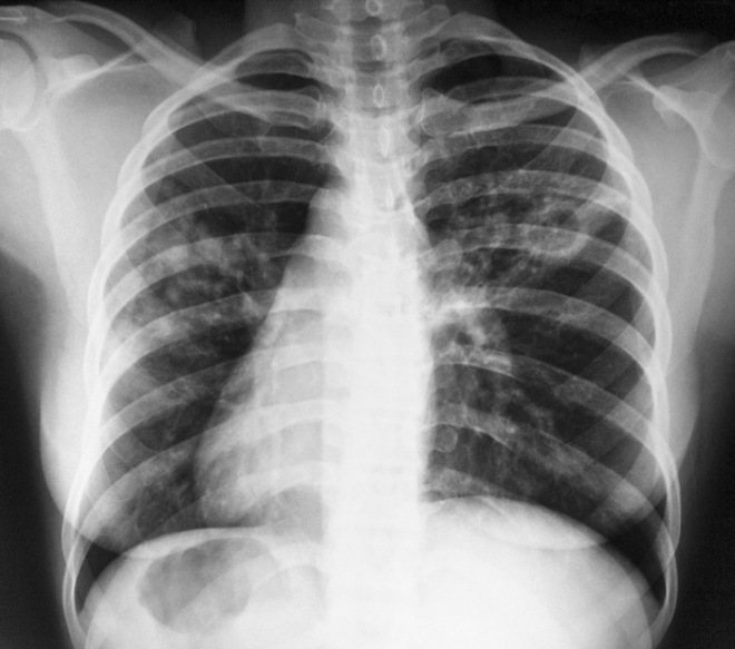 Туберкульоз легень на флюорограмме