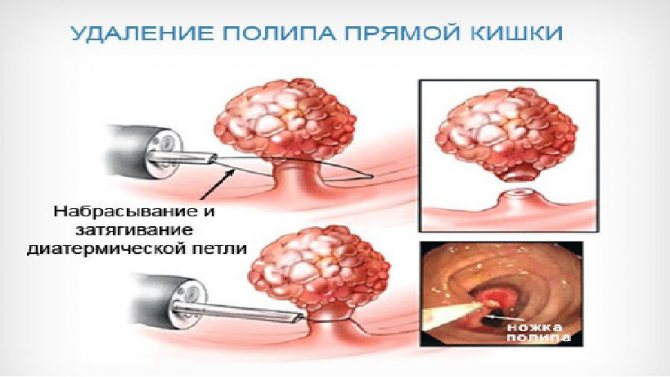 Колоноскопія кишечника – що це таке і як підготуватися?