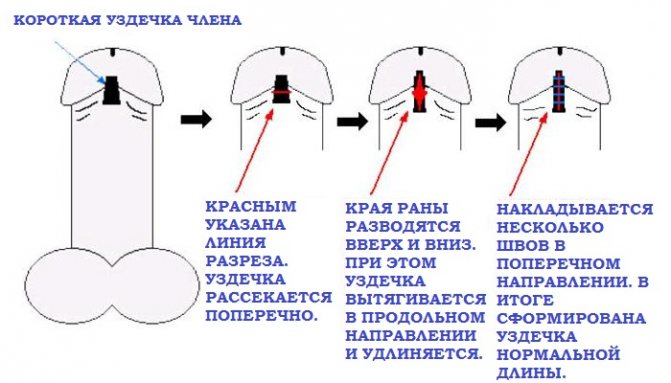 Подовження вуздечки найефективнішим способом