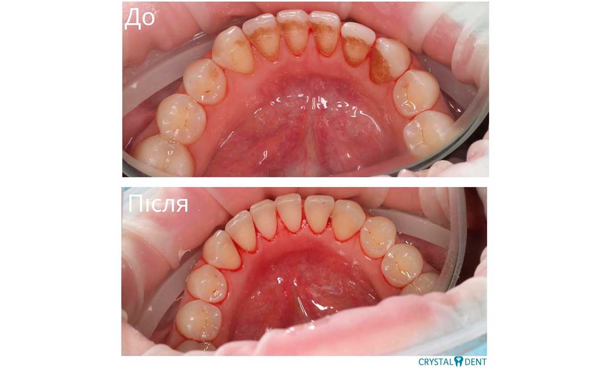 Наглядный результат профессиональной чистки зубов