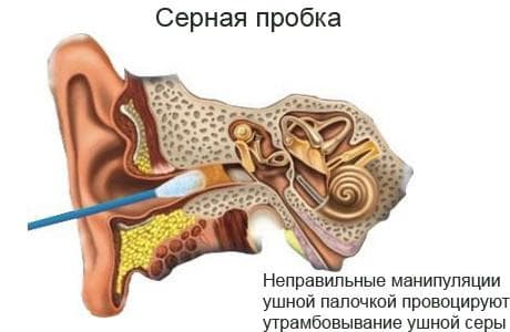 вушні пробки симптоми і лікування