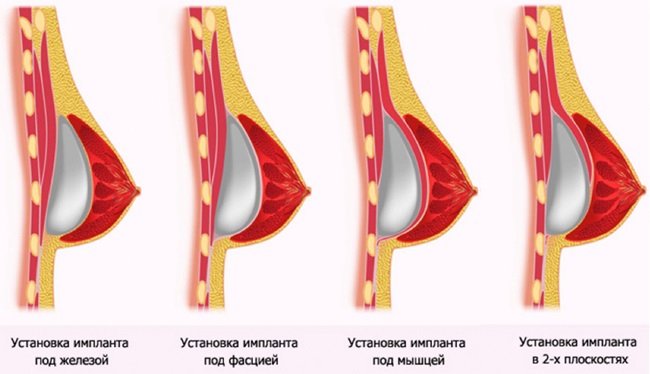 Установка імпланта під грудний м'яз: особливості, переваги та недоліки методу