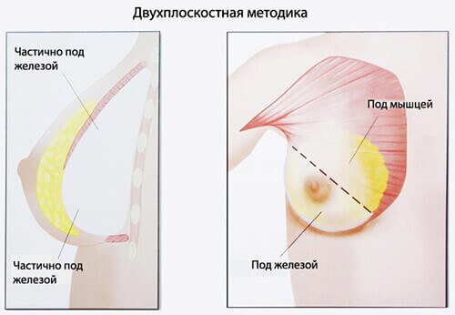 Установка імпланта під грудний м'яз: особливості, переваги та недоліки методу