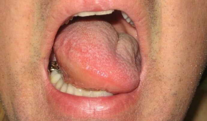 Наліт на мові – види, причини, фото, як очистити і прибрати